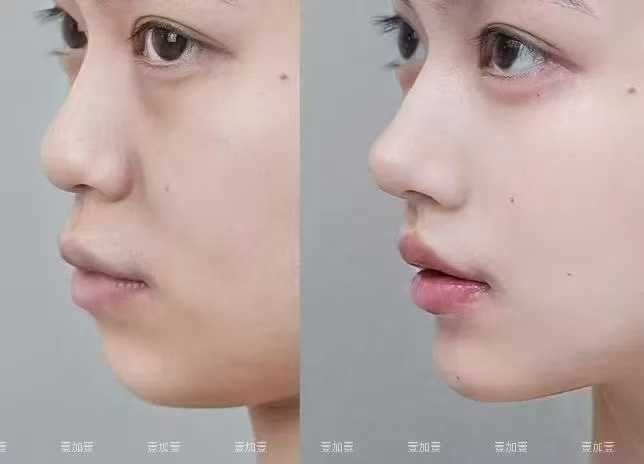 西安新長安婦產(chǎn)科醫(yī)院小陰唇整形優(yōu)勢