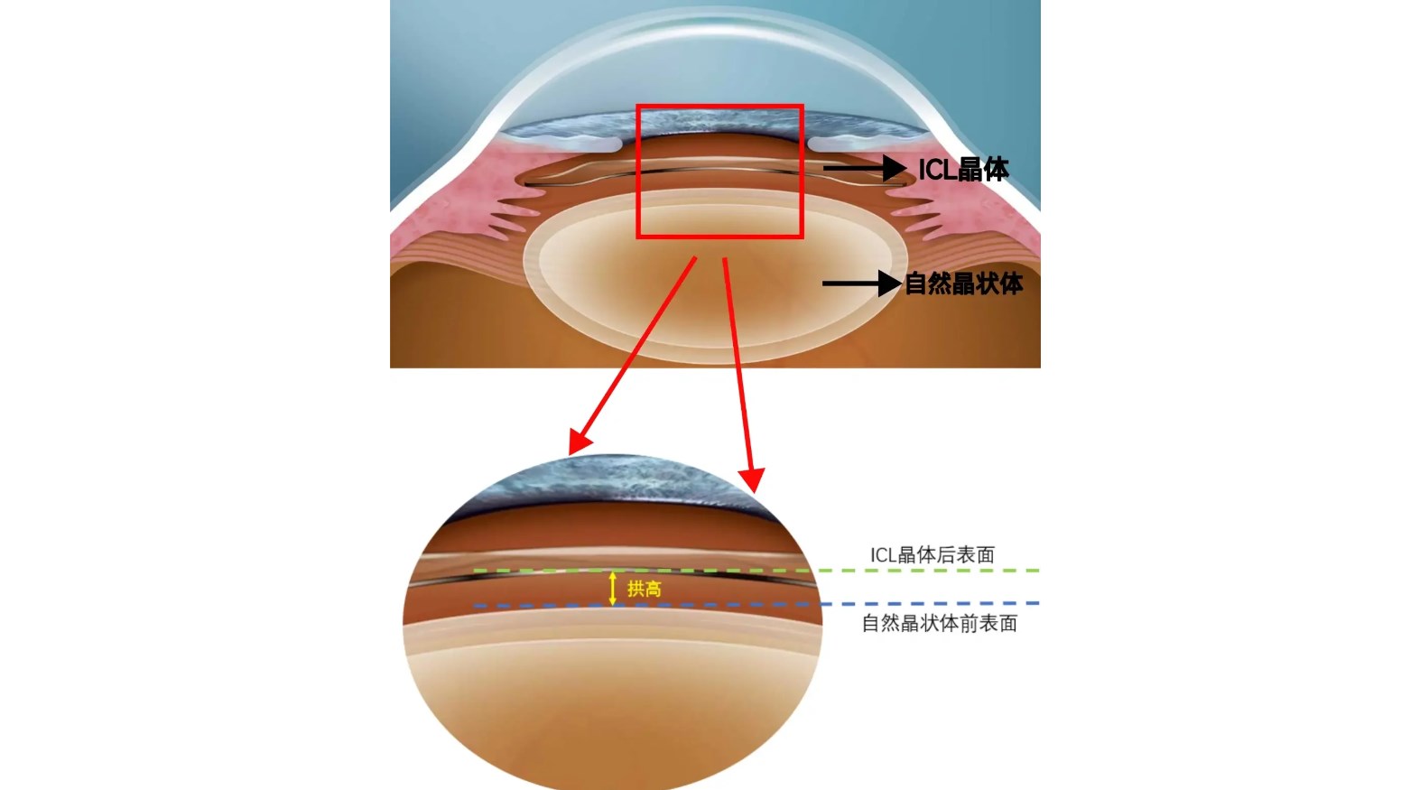 許昌做近視手術(shù)要多少錢？更終總結(jié)及建議