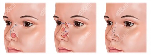 20251203108018.jpg 鼻缺失修復(fù).jpg