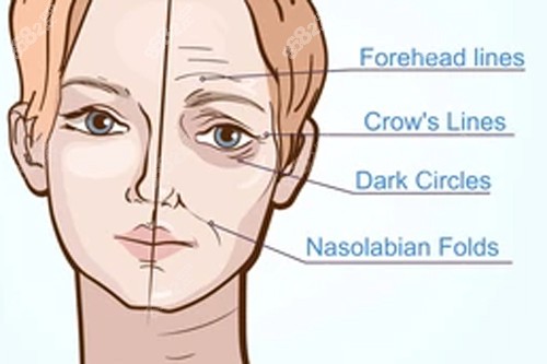 人體衰老形成的不同皺紋.jpg