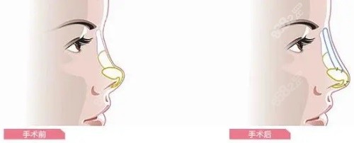 隆鼻前后對(duì)比圖