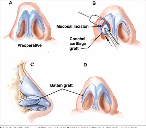 20251203848541.jpg 修復(fù)畸形鼻.jpg