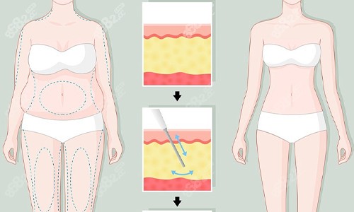 全身吸脂展示圖
