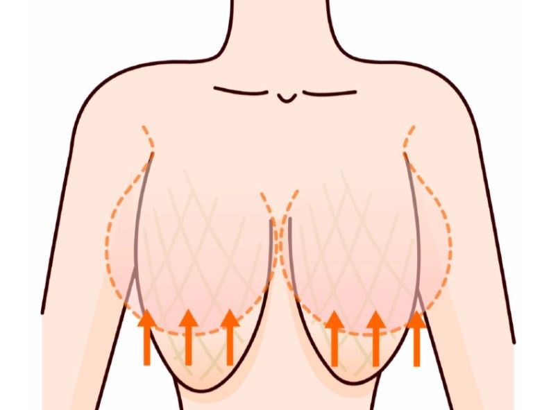 無錫李建東維維提升≠乳房懸吊