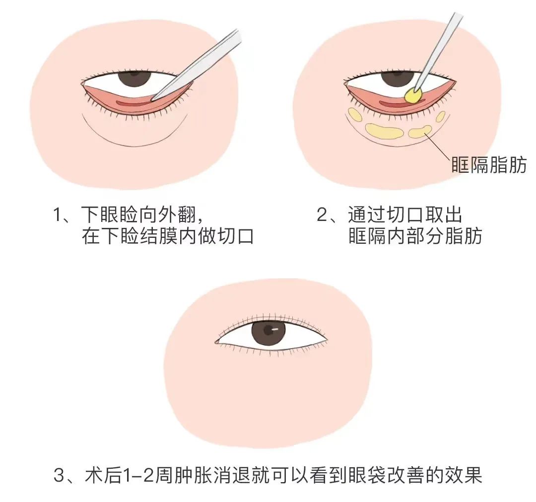 長春眼瞼外翻手術(shù)整形醫(yī)院（私立）技術(shù)對比