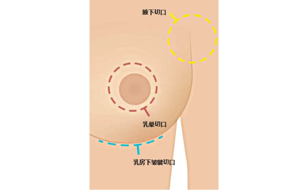 國(guó)內(nèi)正規(guī)醫(yī)院自體脂肪填充豐胸價(jià)格表