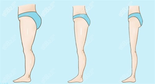 大腿吸脂瘦身前后