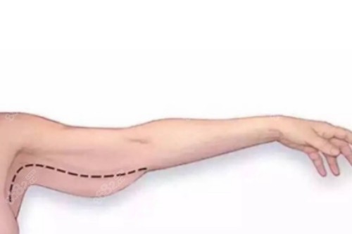 手臂吸脂