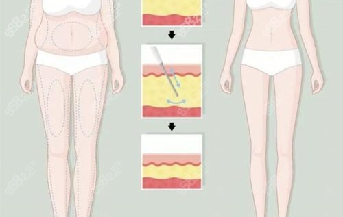 大腿環(huán)吸前后對比卡通示意圖