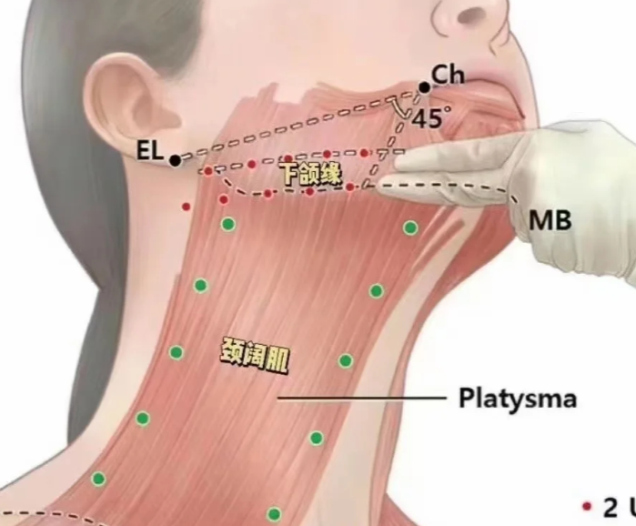 魏廣運頸闊肌拉皮一個月成效分享: