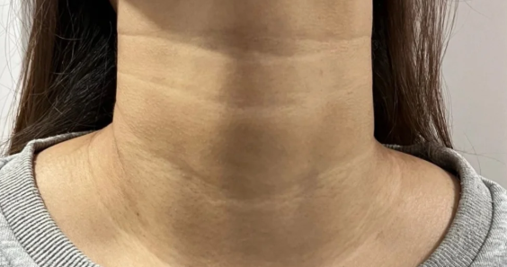 魏廣運頸闊肌拉皮去頸紋:成效背后的技術(shù)邏輯