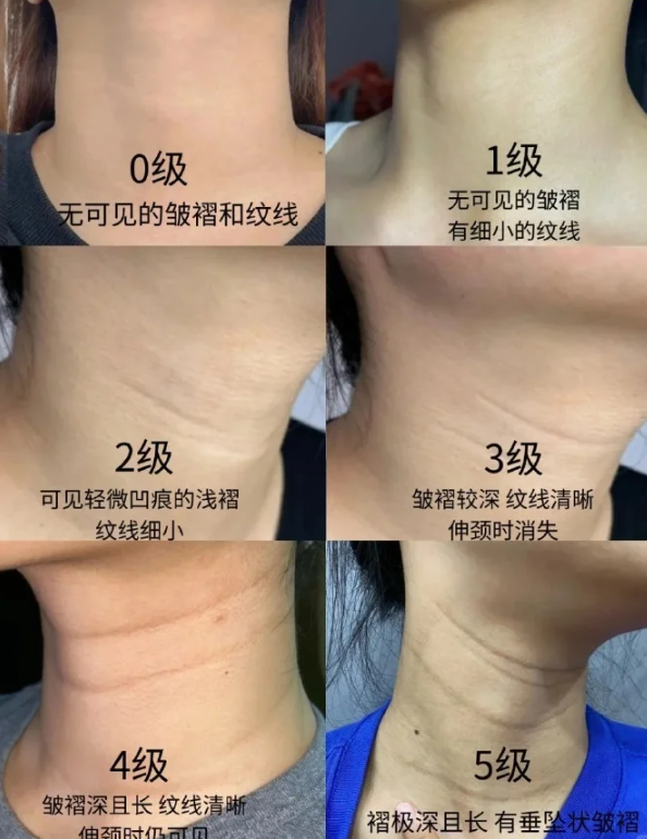 魏廣運頸闊肌拉皮去頸紋:術(shù)前需明確的關(guān)鍵要點