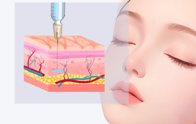 超聲炮和下頜緣提升針項(xiàng)目介紹