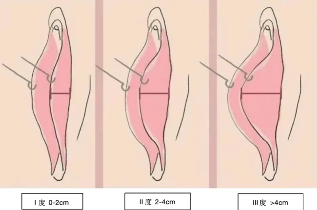 北京外陰整形手術哪家醫(yī)院做得好