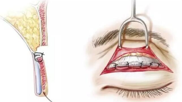 帕克眼綜合包含哪些項目？按需組合適配不同需求