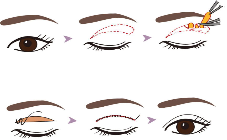 帕克眼綜合成效怎么樣？真實范例見證理想療效