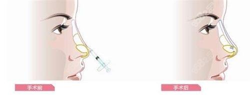 寶尼達(dá)隆鼻