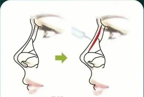 寶尼達(dá)隆鼻