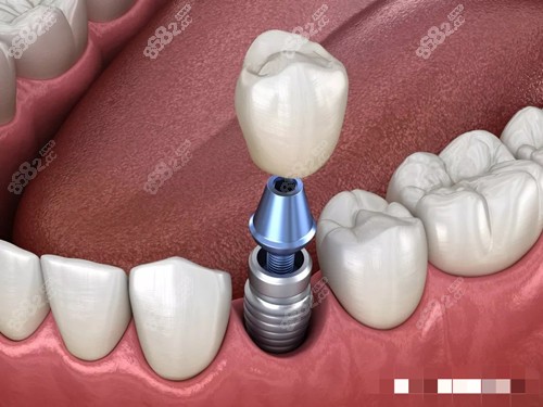 種植牙