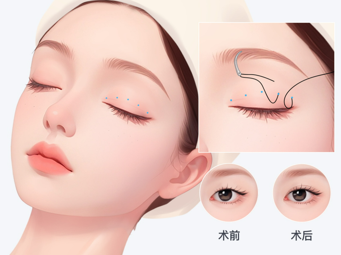 楊晨光雙眼皮修復收費標準