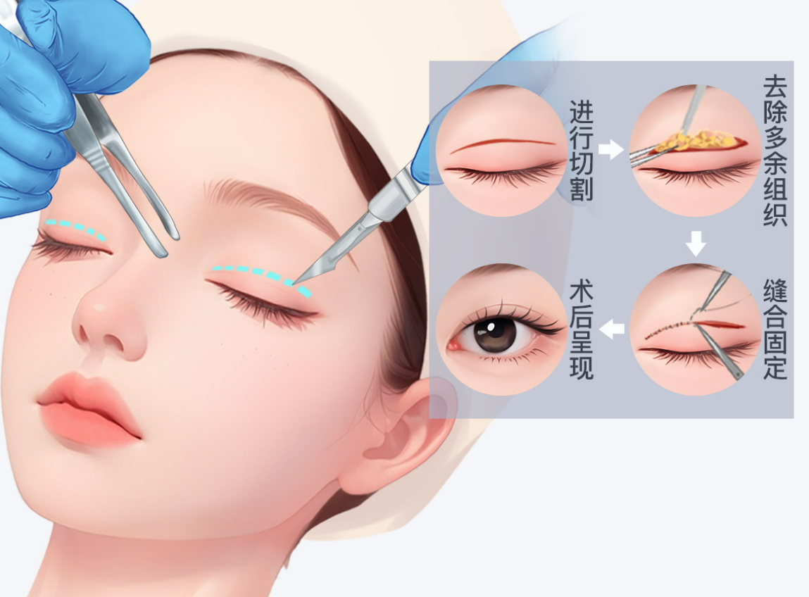 楊晨光雙眼皮修復多少錢