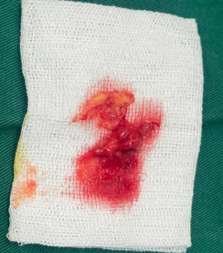 張立彬修復(fù)生長因子費用貴不貴