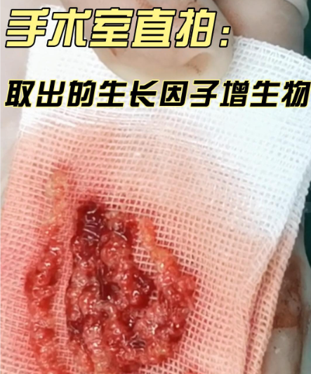 北京張立彬修復(fù)生長(zhǎng)因子真實(shí)圖片