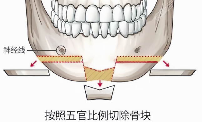 萬啟龍頦成型費用多少錢