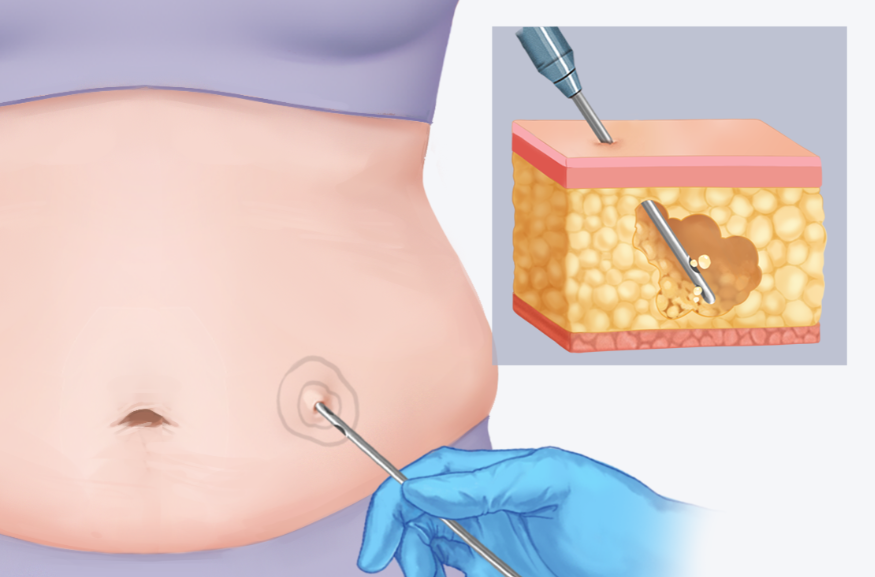 邯鄲吸脂哪家醫(yī)院好