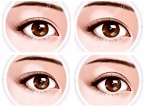 雙眼皮得不同形態(tài)