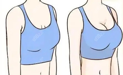 胸部整形前后對比卡通示意圖 胸部整形前后對比卡通示意圖