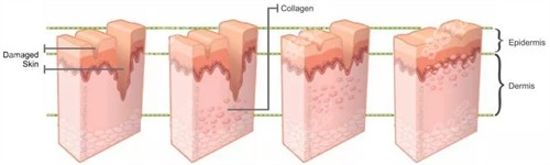 凹陷疤痕填充前后對比