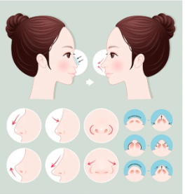   杭州劉軍做鼻子好嗎？本地人實測：找他做耳軟骨鼻綜合15800元起值不值