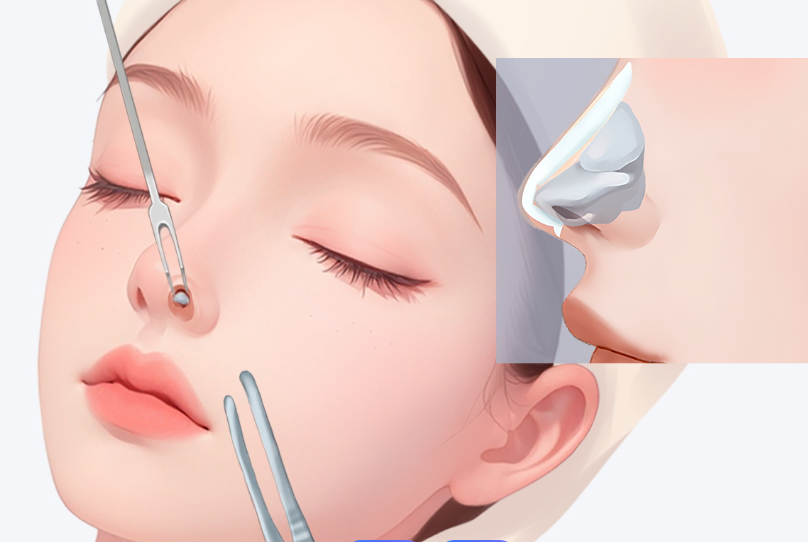 劉軍鼻綜合手術實例分享