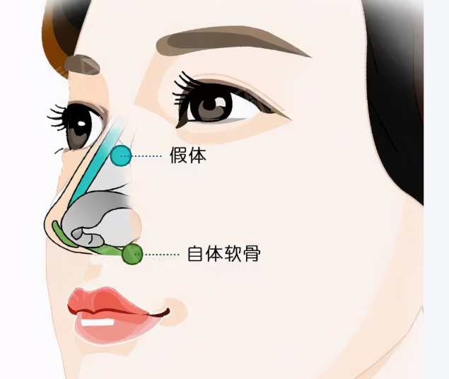 武漢藝星楊國梁隆鼻價格2025最新版：肋軟骨3.8萬起，鼻修復(fù)4.5萬起技術(shù)穩(wěn)很值