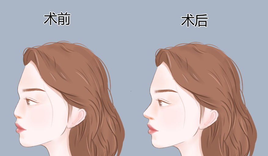 武漢藝星楊國梁隆鼻實(shí)例