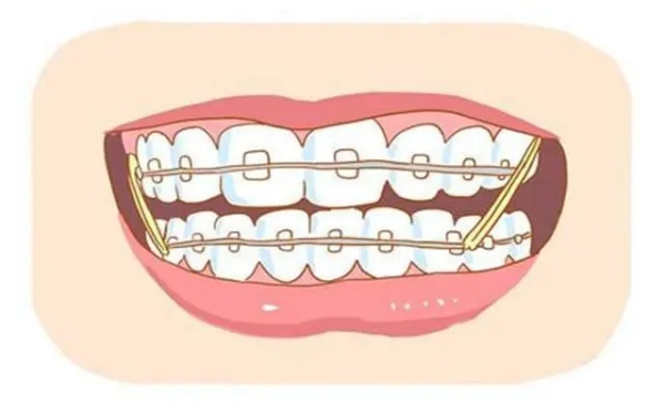 六、正畸每次都需要同一個醫(yī)生嗎？專門建議