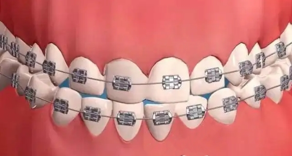 七、正畸每次都需要同一個醫(yī)生嗎？特殊人群注意事項