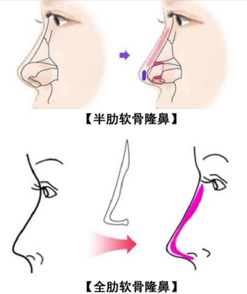 李長富醫(yī)生鼻綜合技術(shù)的核心優(yōu)勢www.66ub.cn