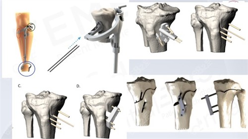 腿型矯正手術(shù)步驟演示圖 腿型矯正手術(shù)步驟演示圖