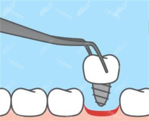 拔牙卡通圖片 拔牙卡通圖片