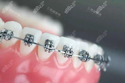牙齒矯正牙套金屬托槽矯正 牙齒矯正牙套金屬托槽矯正