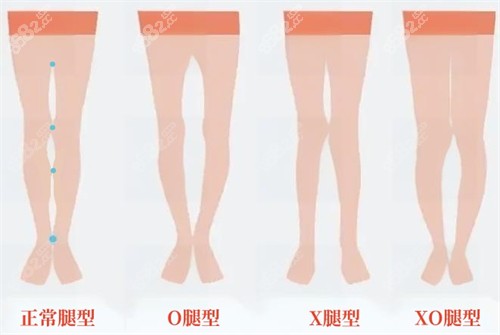 不同腿型對比動畫圖 不同腿型對比動畫圖