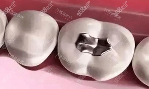 銀汞合金的補(bǔ)牙術(shù)后 銀汞合金的補(bǔ)牙術(shù)后