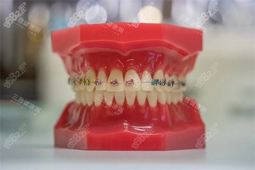 牙齒矯正宣傳展示 牙齒矯正宣傳展示