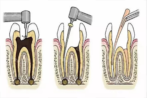 根管治療步驟1 根管治療步驟1