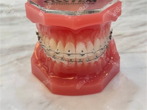 牙齒矯正陶瓷托槽牙套模型圖 牙齒矯正陶瓷托槽牙套模型圖