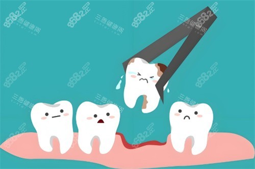 拔牙動畫示圖 拔牙動畫示圖