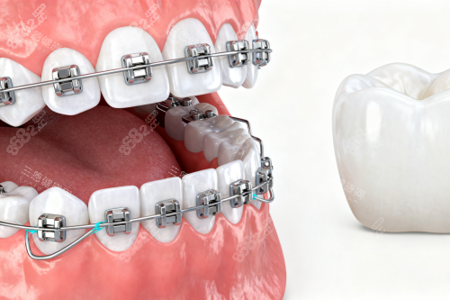 牙齒矯正卡通展示 牙齒矯正卡通展示