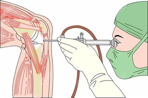 腿型矯正手術(shù)直腿術(shù)演示圖 腿型矯正手術(shù)直腿術(shù)演示圖